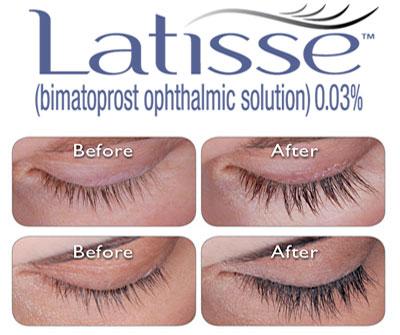 latisse
