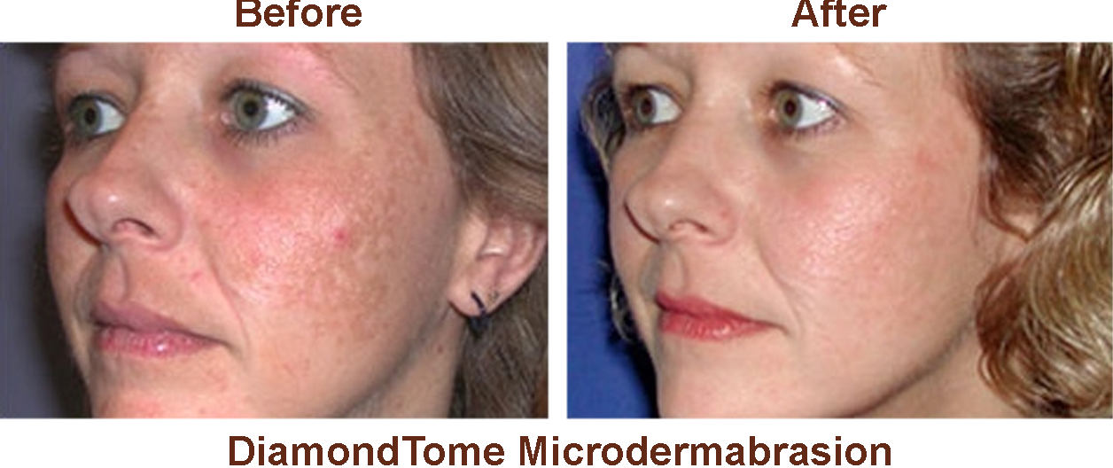 Microdermabrasion before and after pictures